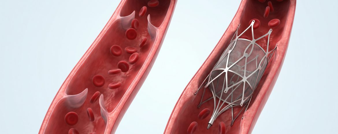 ivc filter