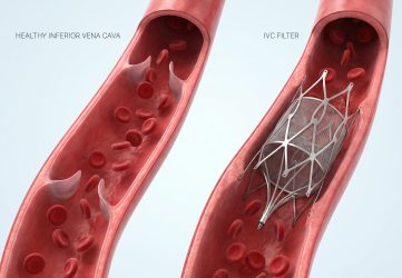 ivc filter