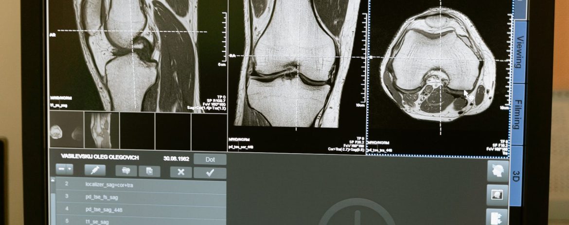 exactech knee and hip replacement